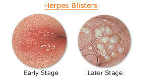 Herpes Blisters