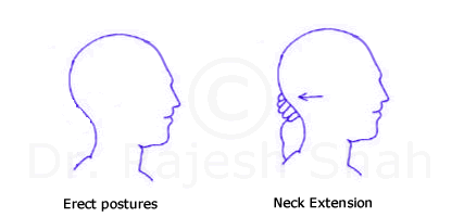 Neck extension for cervical spondylitis