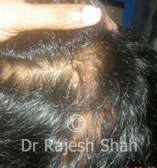 Lichen planopilaris on scalp