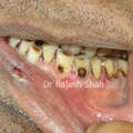 Lichen Planus of Mouth on Lower Front Teeth Gums
