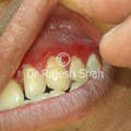 Lichen Planus of Mouth on Upper Front Teeth Gums