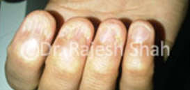 Fingers with Lichen Planus Infection