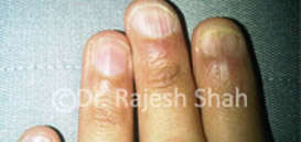 Nails Infected with Lichen Planus