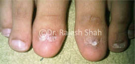 Toe Nails with Lichen Planus