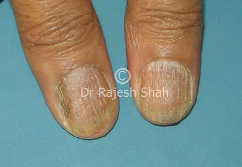 Fixing Damaged Nails. What are the best treatments? By K.Waller - Compleet  Feet