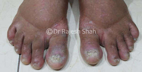 Lichen Striatus, Nail, Leg, Ijdvl, Face, Diagnosis, Cure, Pathology  Treatment in Homeopathy