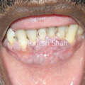 Homeopathic Treatment for Oral Lichen Planus