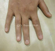 Hand Nails Lichen Planus
