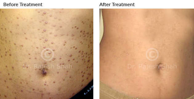 lichne_planus_before_after_5