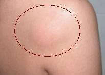 Lipoma on dhoulders