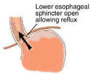 Lower Esophageal Sphincter Open