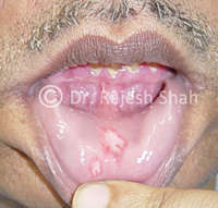 Ulcers in Mouth