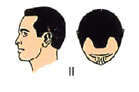 wedge-shaped pattern hair loss