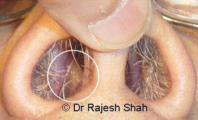 Nasal polyps before treatment