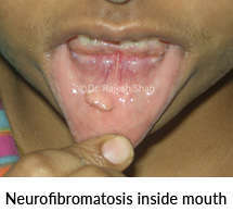 Neurofibromatosis inside mouth