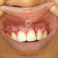 Oral Lichen Planus on Gums Before Treatment