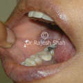 Causes of Oral Lichen Planus 