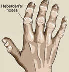 Osteoarthritis Nodes Fingers