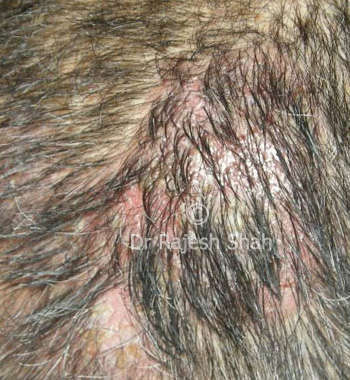 pemphigus-vulgaris-affecting-head