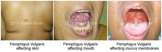 photos_demonstrating_affecting_from_pemphigus_vulgaris
