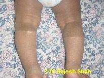 Piebaldism on baby leg