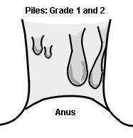 Piles grade 1 and 2