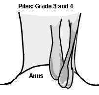 Piles grade 3 and 4