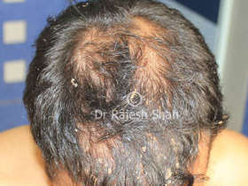 Psoriasis patches in scalp