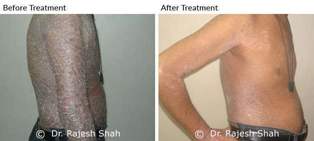 Psoriasis on body before after treatment picture