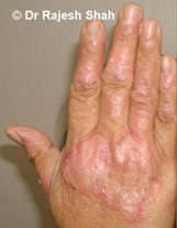 psoriasis-hand-photo