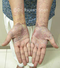 Lichen planus and psoriasis in palms