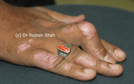 Psoriatic arthritis on Fingers