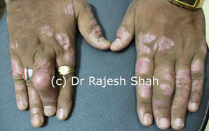 Photo of psoriatic arthritis