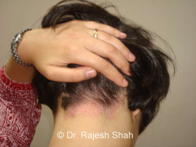 scalp psoriasis and tinnitus)