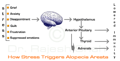 Stress Can Cause Alopecia Areata