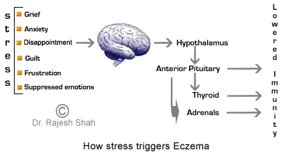 Stress and eczema