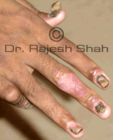 Finger nail with Psoriatic arthritis