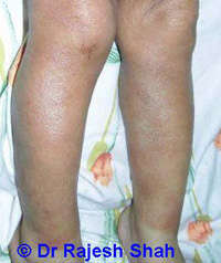 Symptoms of Eczema on Legs