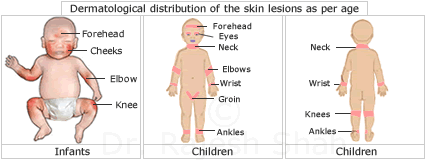 Atopic dermatitis in infants and children