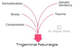 Understand trigeminal neuralgia causes