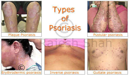 Psoriasis types