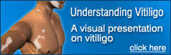 what is Vitiligo? A presentation