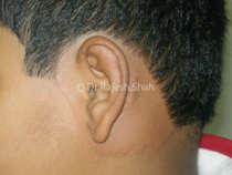 Urticaria near ear