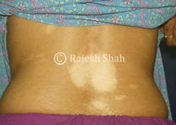 Vitiligo Spots on back
