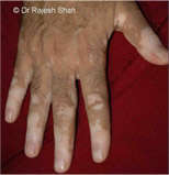 Vitiligo on Fingers
