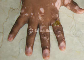 Vitiligo on Fingers & Between Fingers