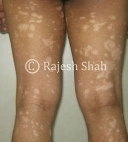 Vitiligo on thighs