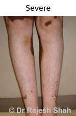 Severe Vitiligo Treatment