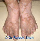 Vitiligo on Feet