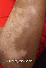 Vitiligo on elbow